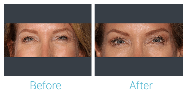 Botox Before & After Gallery - Patient 58152150 - Image 1