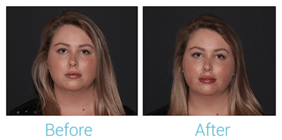 Fillers Before & After Gallery - Patient 154108521 - Image 1