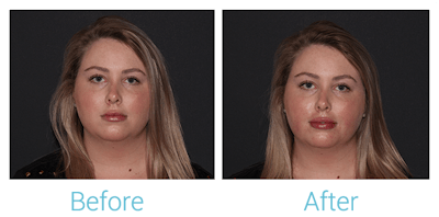 Juvederm Before & After Gallery - Patient 58152147 - Image 1