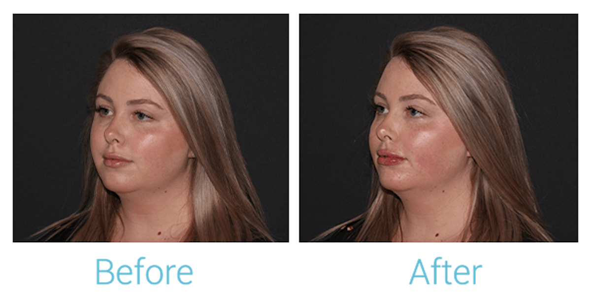 Fillers Before & After Gallery - Patient 154108521 - Image 2