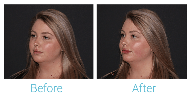 Juvederm Before & After Gallery - Patient 58152147 - Image 2