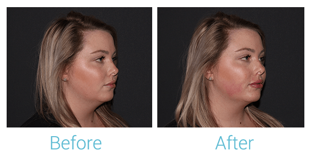 Juvederm Before & After Gallery - Patient 58152147 - Image 3