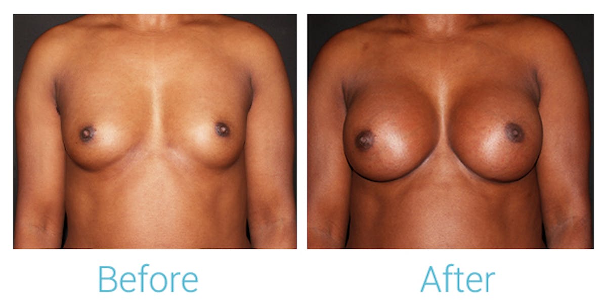 Breast Augmentation Before & After Gallery - Patient 106048606 - Image 1