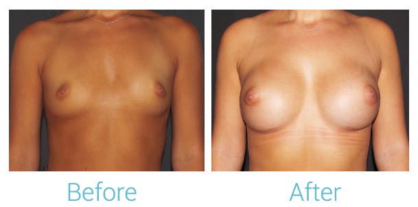 Breast Augmentation Before & After Gallery - Patient 106048607 - Image 1