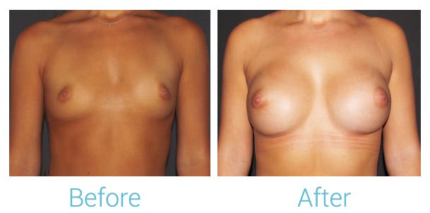 Breast Augmentation Before & After Gallery - Patient 106048607 - Image 1