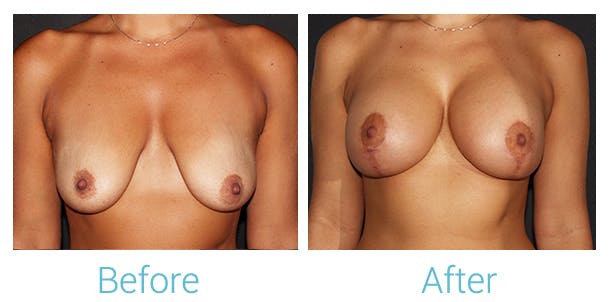 Breast Augmentation Before & After Gallery - Patient 106048608 - Image 1