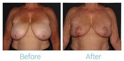 Breast Reduction Before & After Gallery - Patient 106048612 - Image 1