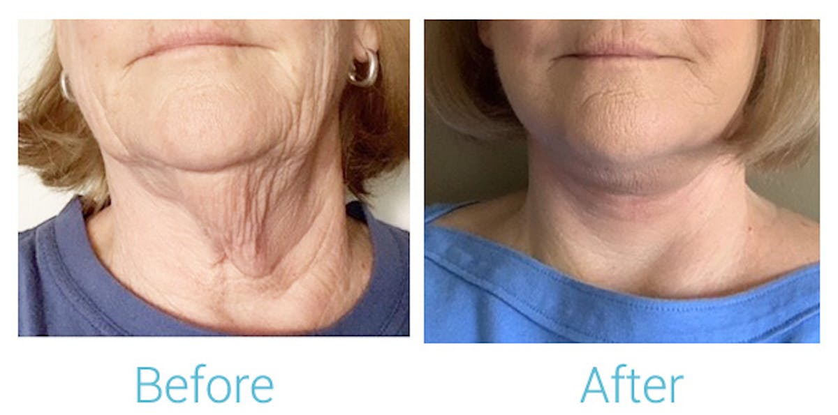 Neck Lift Before & After Gallery - Patient 141442289 - Image 1