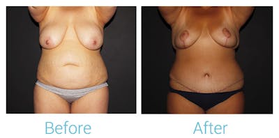 Mommy Makeover Before & After Gallery - Patient 141443725 - Image 1