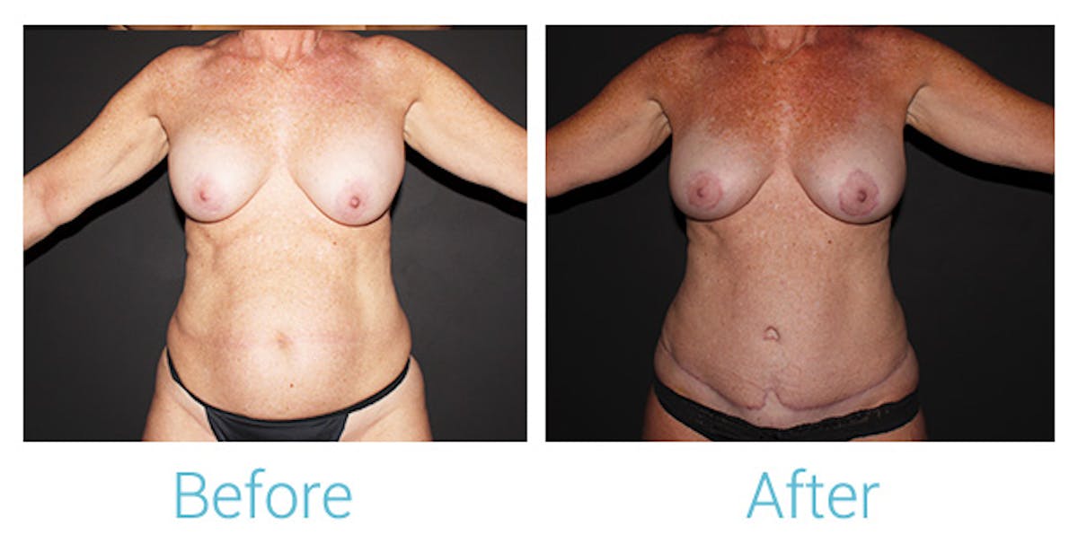Mommy Makeover Before & After Gallery - Patient 141443726 - Image 1