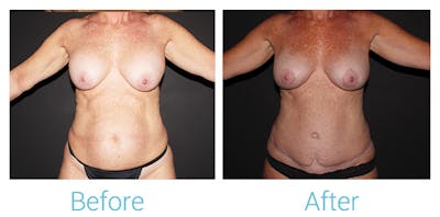 Mommy Makeover Before & After Gallery - Patient 141443726 - Image 1