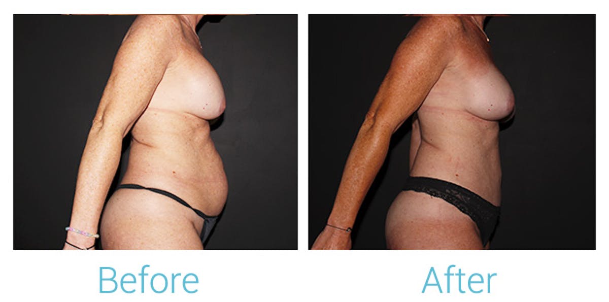 Mommy Makeover Before & After Gallery - Patient 141443726 - Image 2