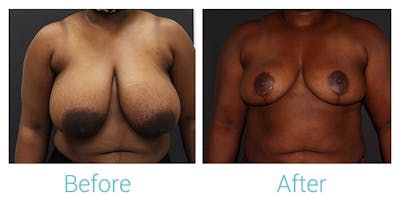 Breast Lift Gallery - Patient 141443879 - Image 1