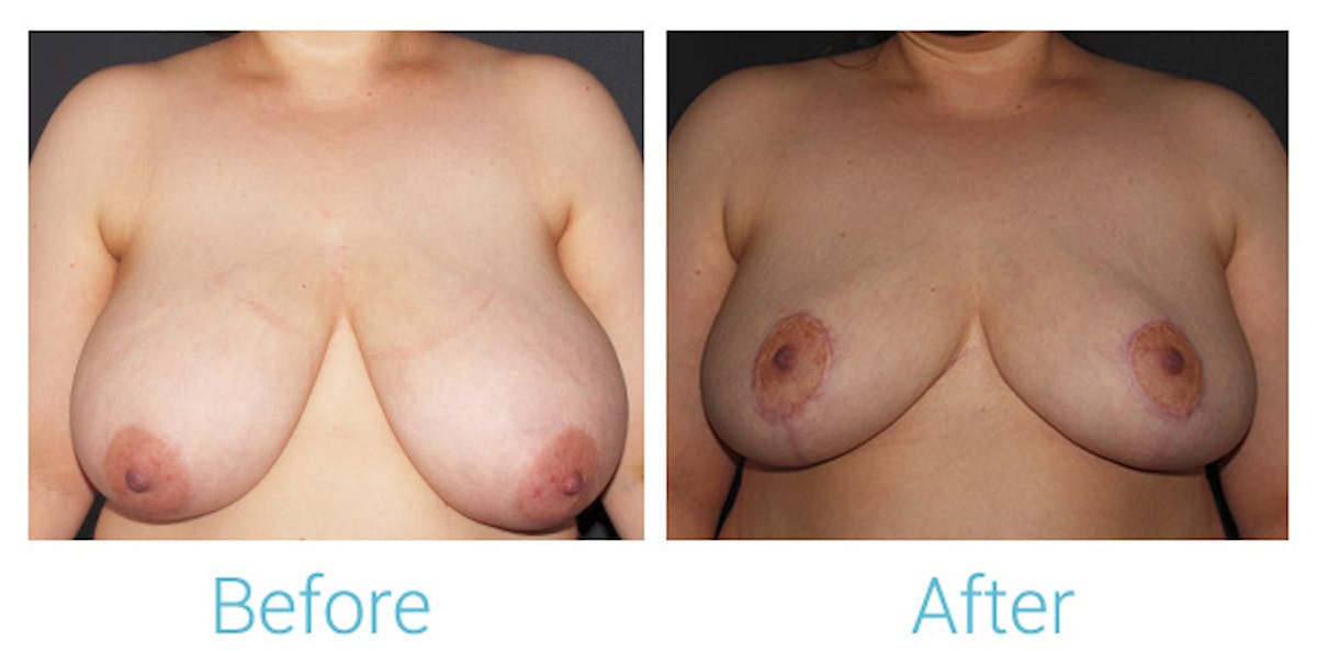 Breast Lift Before & After Gallery - Patient 141443880 - Image 1