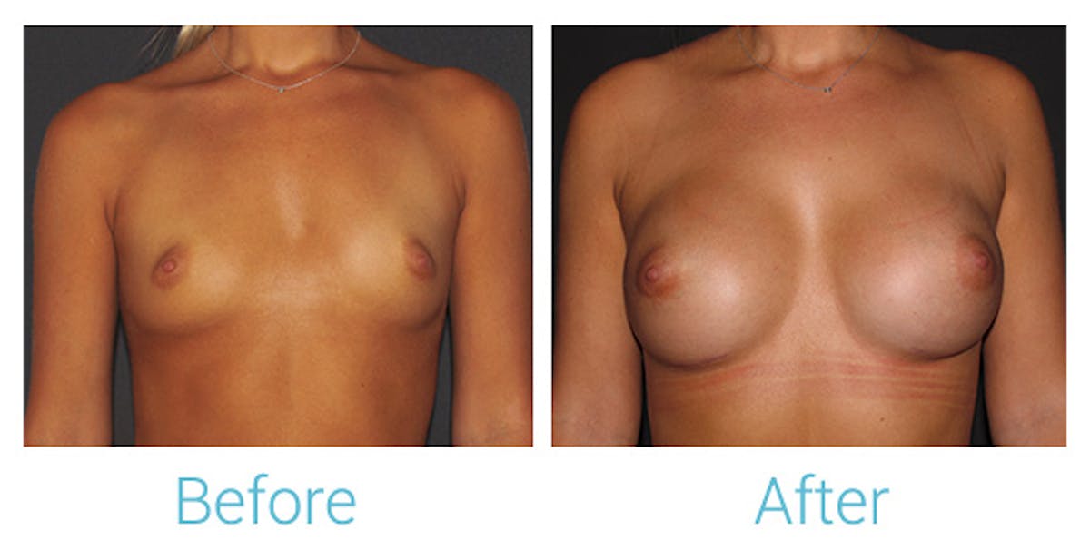 Breast Augmentation Before & After Gallery - Patient 141443991 - Image 1