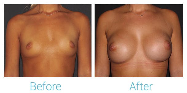 Breast Augmentation Before & After Gallery - Patient 141443991 - Image 1