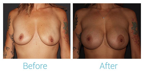 Breast Augmentation Gallery - Patient 141443990 - Image 1