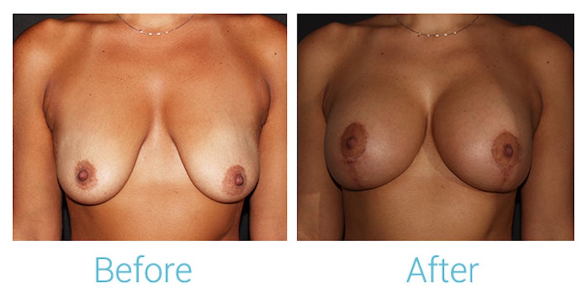 Breast Augmentation Before & After Gallery - Patient 141443989 - Image 1