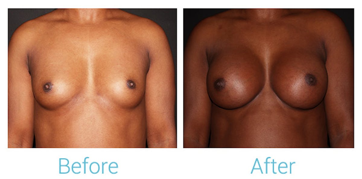 Breast Augmentation Before & After Gallery - Patient 141443988 - Image 1