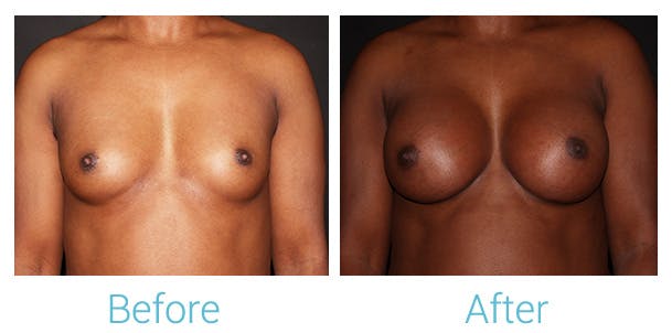Breast Augmentation Gallery - Patient 141443988 - Image 1