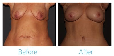 Breast Reconstruction Before & After Gallery - Patient 141444002 - Image 1