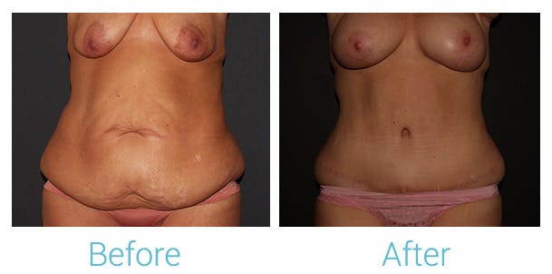 Tummy Tuck Gallery - Patient 141444567 - Image 1