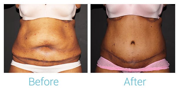 Tummy Tuck Before & After Gallery - Patient 141444566 - Image 1