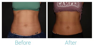 CoolSculpting Before & After Gallery - Patient 141470947 - Image 1
