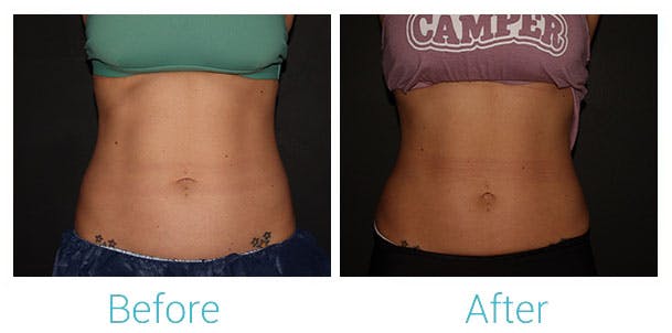 CoolSculpting Before & After Gallery - Patient 141470947 - Image 1
