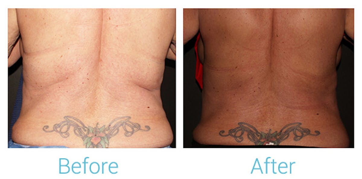 CoolSculpting Before & After Gallery - Patient 184933433 - Image 1