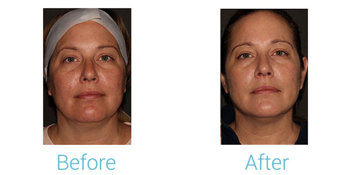 Morpheus8 Before & After Gallery - Patient 184933381 - Image 1