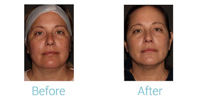 Morpheus8 Before & After Gallery - Patient 184933381 - Image 1