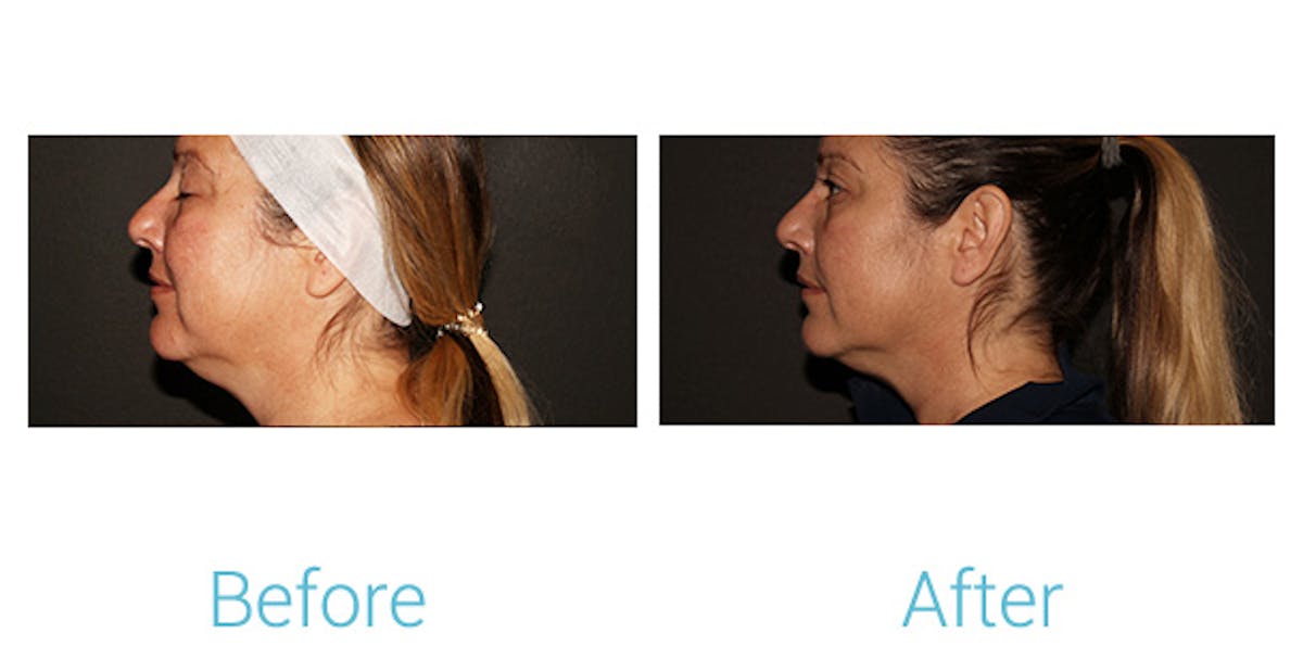 Morpheus8 Before & After Gallery - Patient 184933381 - Image 3