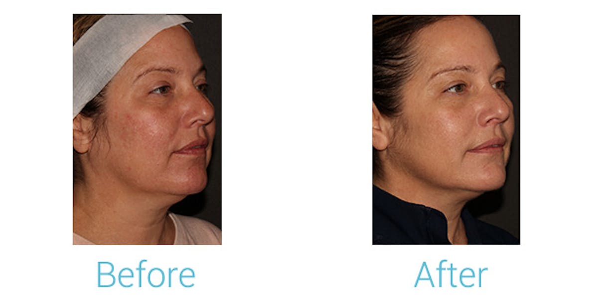 Morpheus8 Before & After Gallery - Patient 184933381 - Image 2