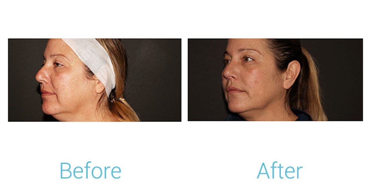 Morpheus8 Before & After Gallery - Patient 184933381 - Image 4