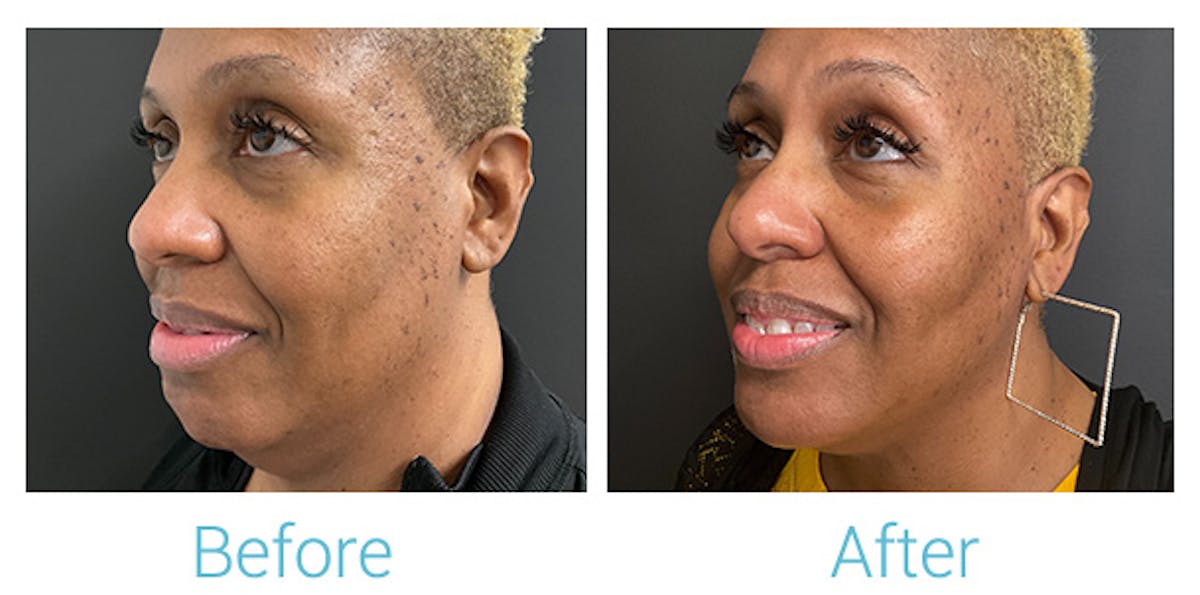Morpheus8 Before & After Gallery - Patient 184933383 - Image 3