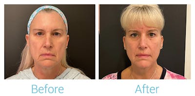 Morpheus8 Before & After Gallery - Patient 184933384 - Image 1