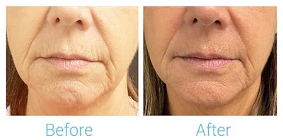 Morpheus8 Before & After Gallery - Patient 223496 - Image 1