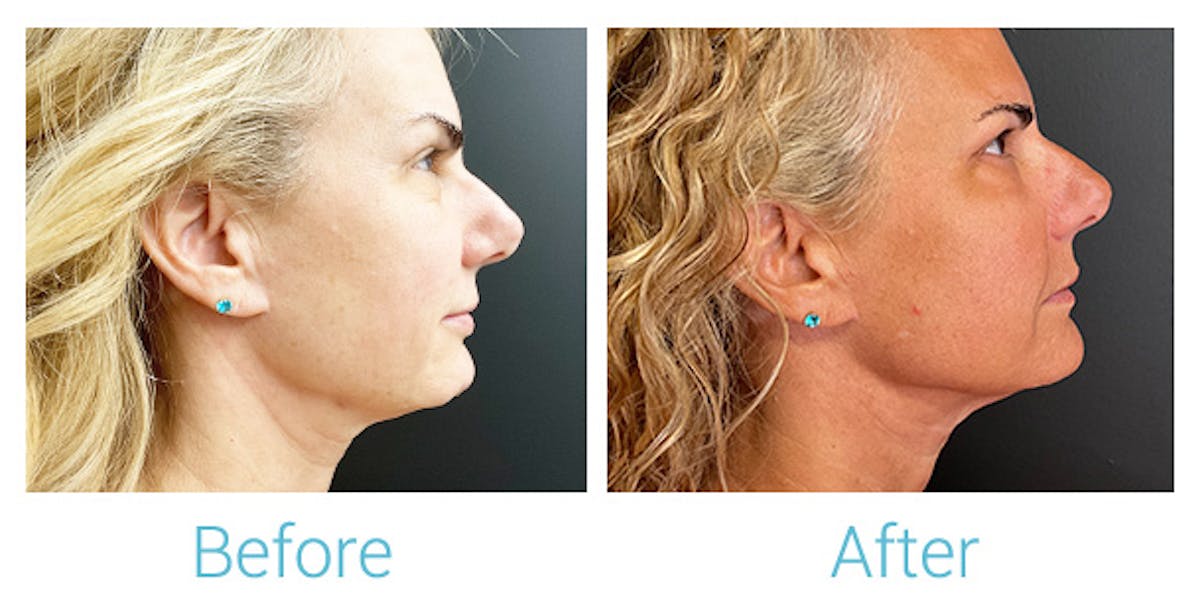 Morpheus8 Before & After Gallery - Patient 392488 - Image 1