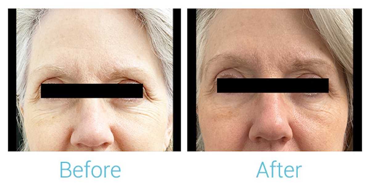 Morpheus8 Before & After Gallery - Patient 336999 - Image 1