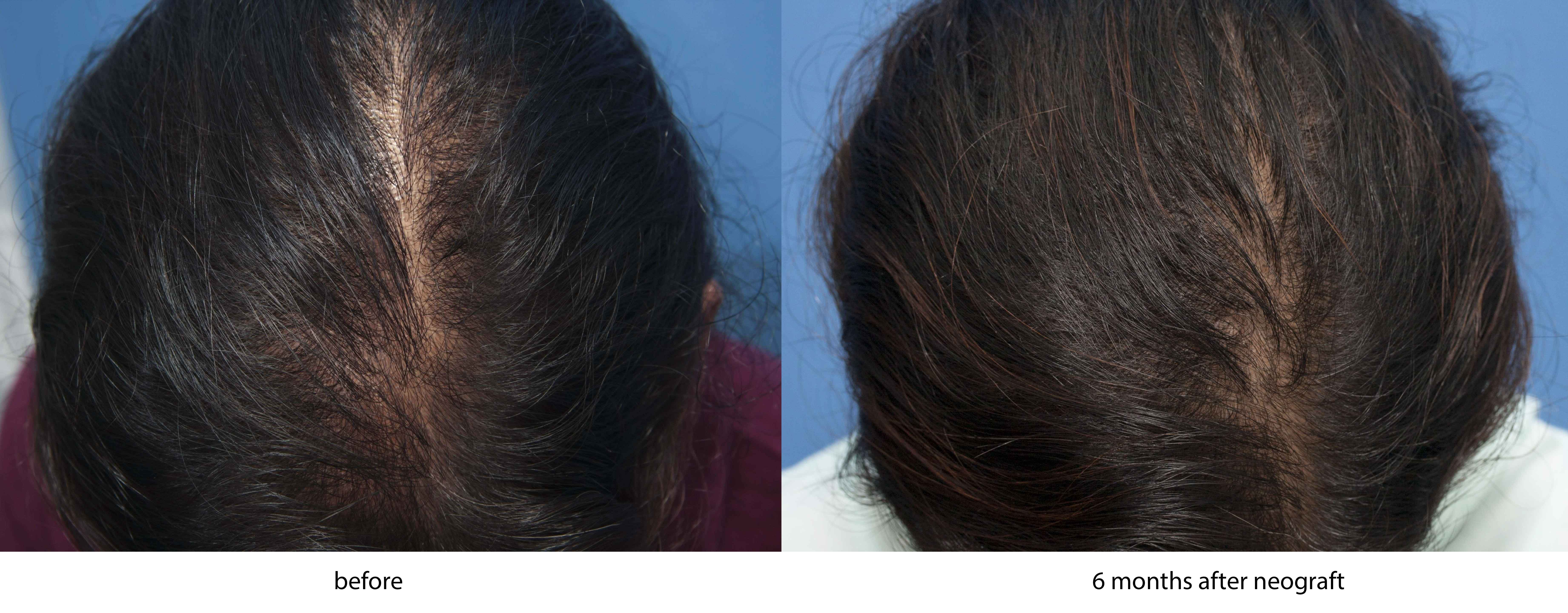 female 6 month before and after hair restoration