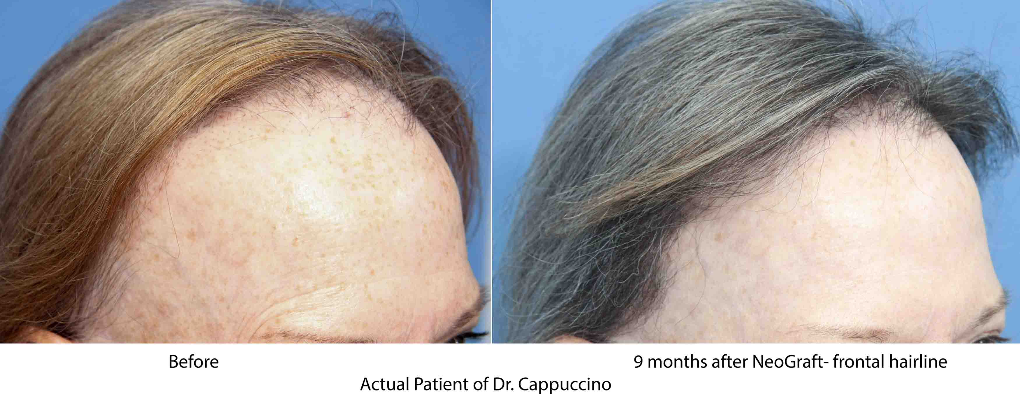 front view of female 6 month before and after hair restoration