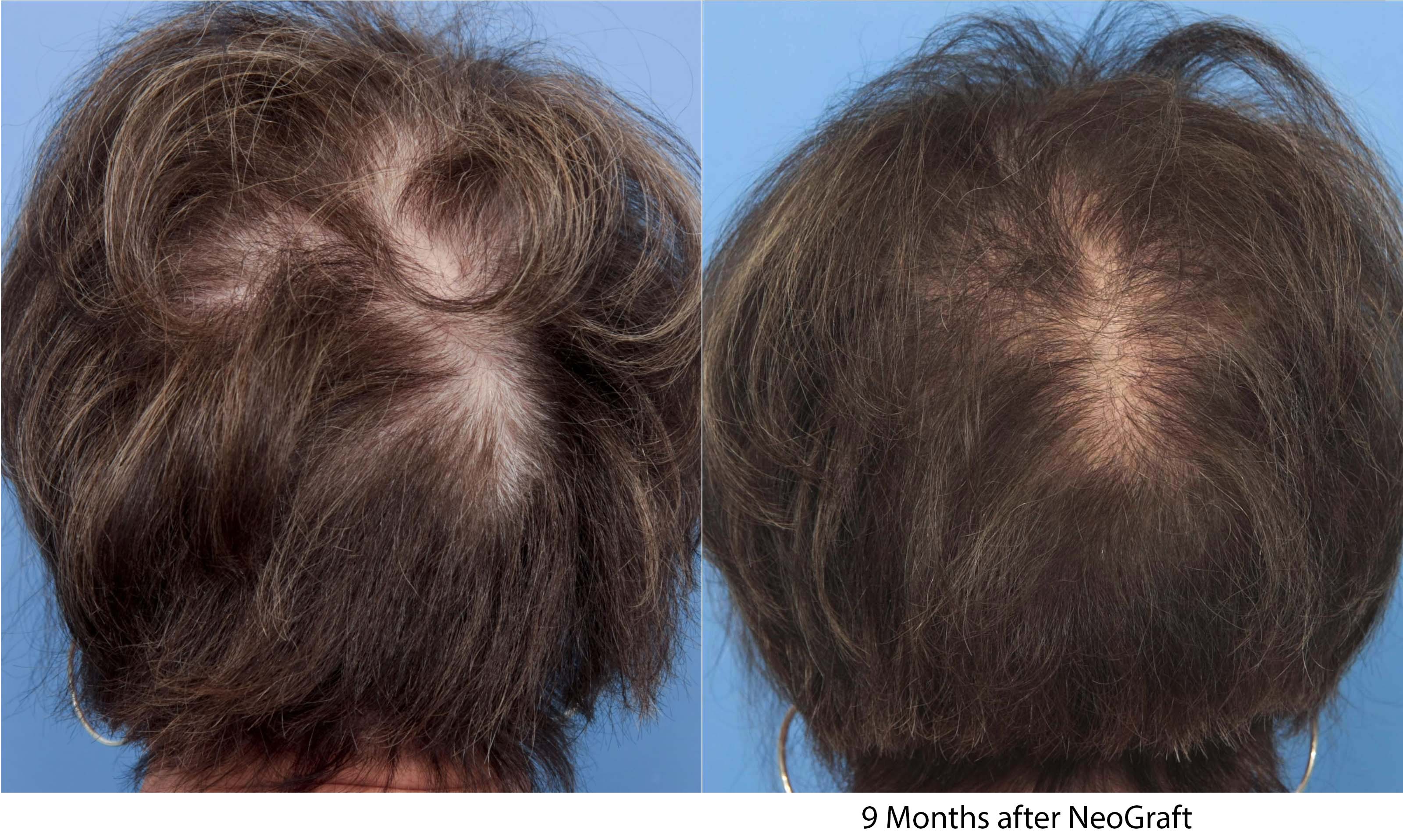 female 9 month before and after hair restoration