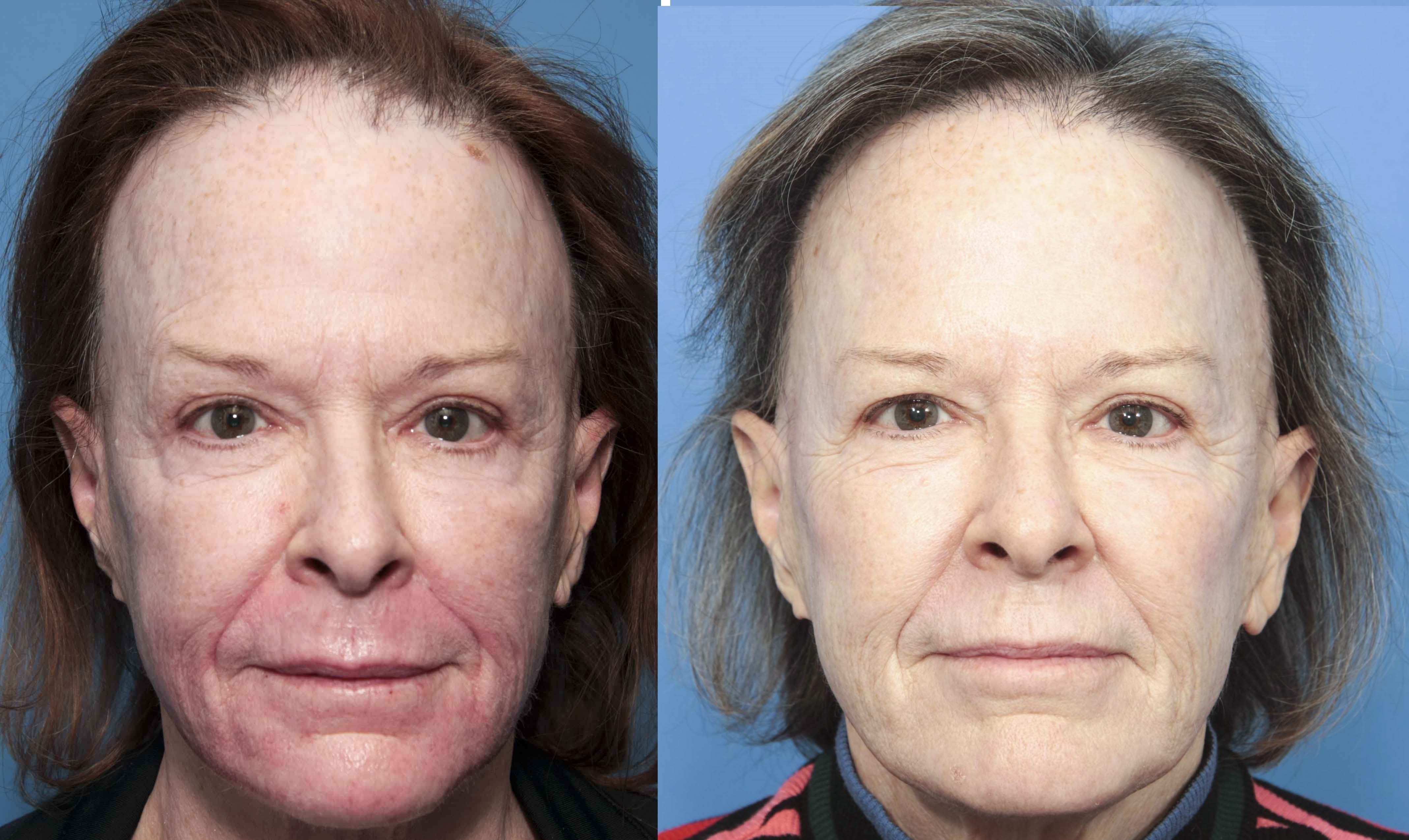 Front view of female 6 month before and after hair restoration