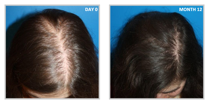 12 month before and after of female patient