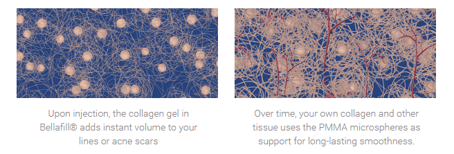 a close up of collagen cells after using Bellafill