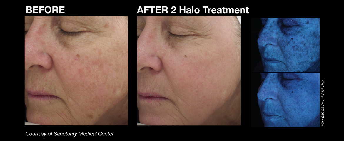 before and after of a patient after their halo laser treatment