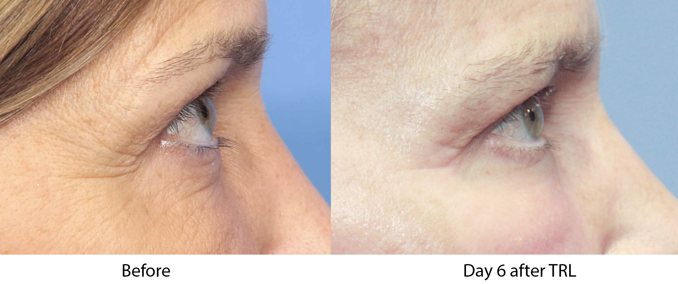 patient profile before and after Contour Tunable Resurfacing Laser 