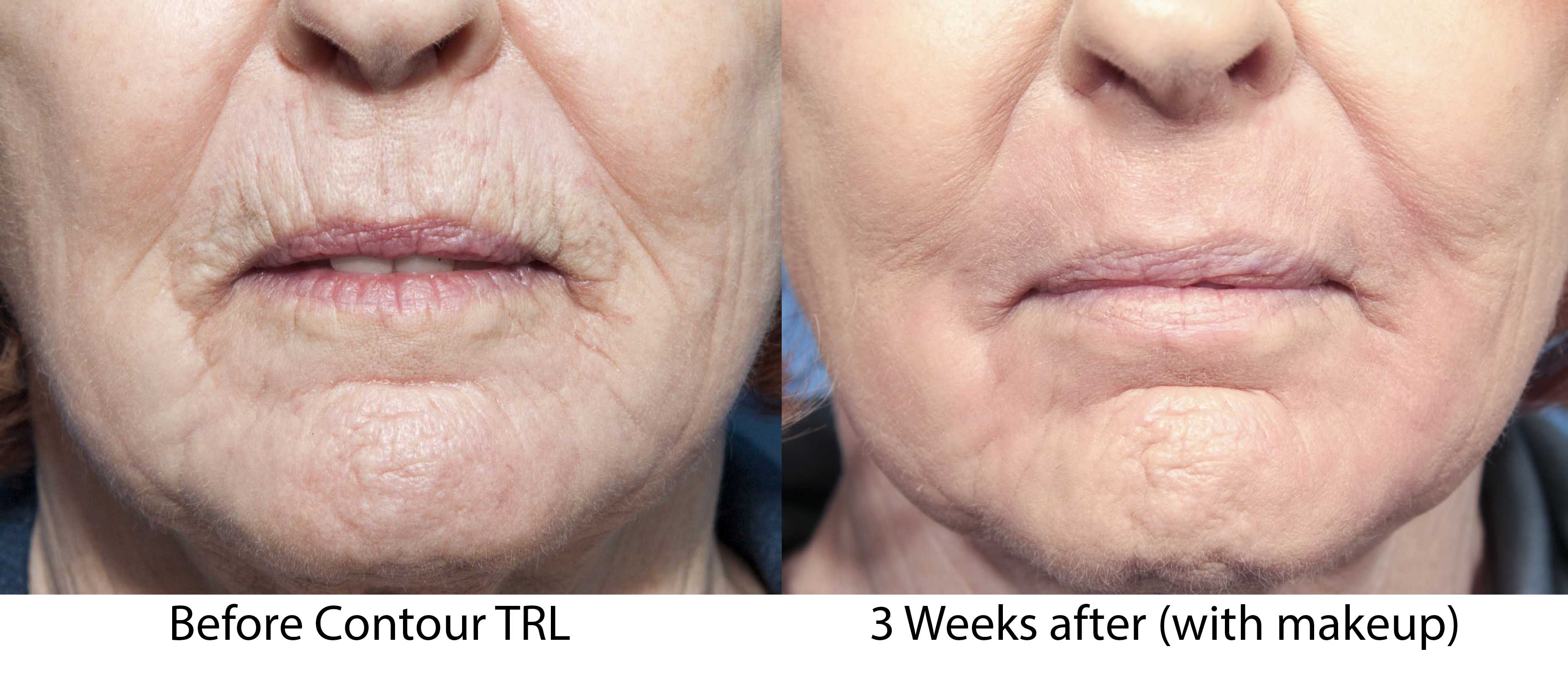 front view of patient before and after Contour Tunable Resurfacing Laser 