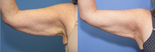Arm Lift Before & After Gallery - Patient 58172289 - Image 1